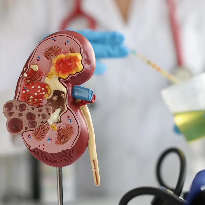 Kidney Swelling