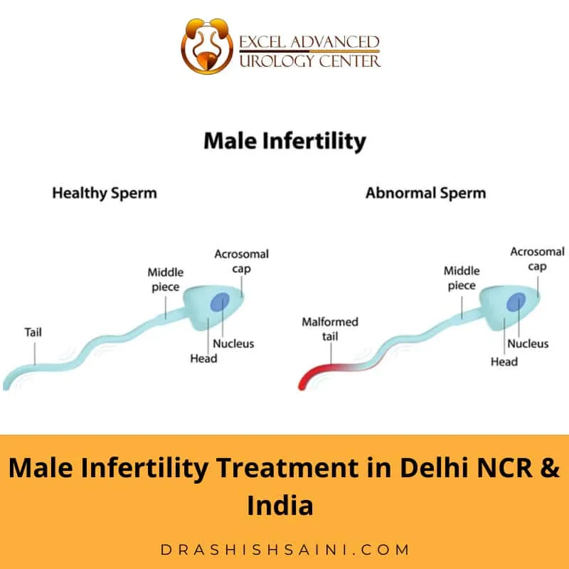 male infertility treatment in delhi