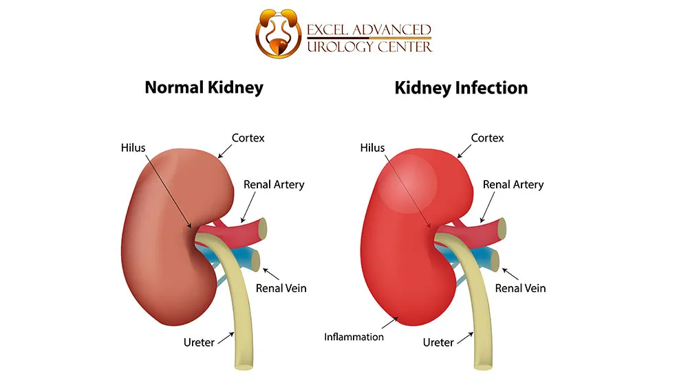 What is PCNL?