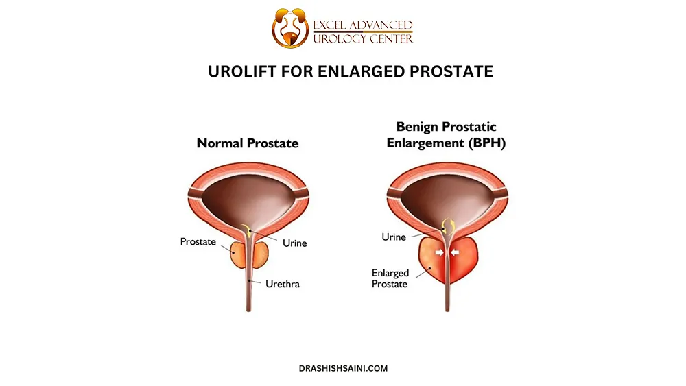 Diagram of different name of Urolift.