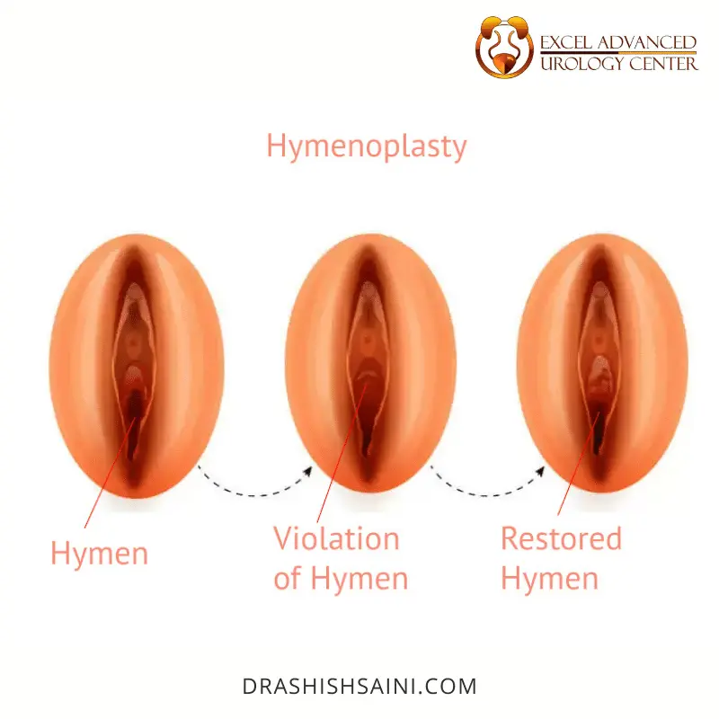 hymenoplasty surgery in delhi - dr ashish saini