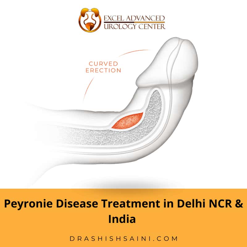 peyronie disease treatment in delhi - dr ashish saini