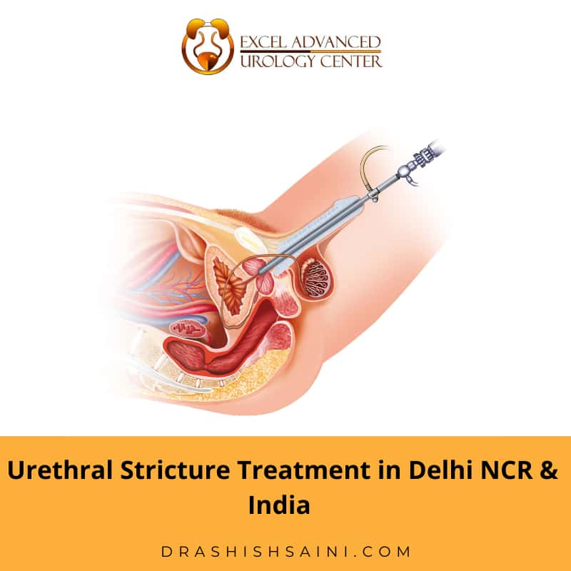 urethral stricture treatment in delhi