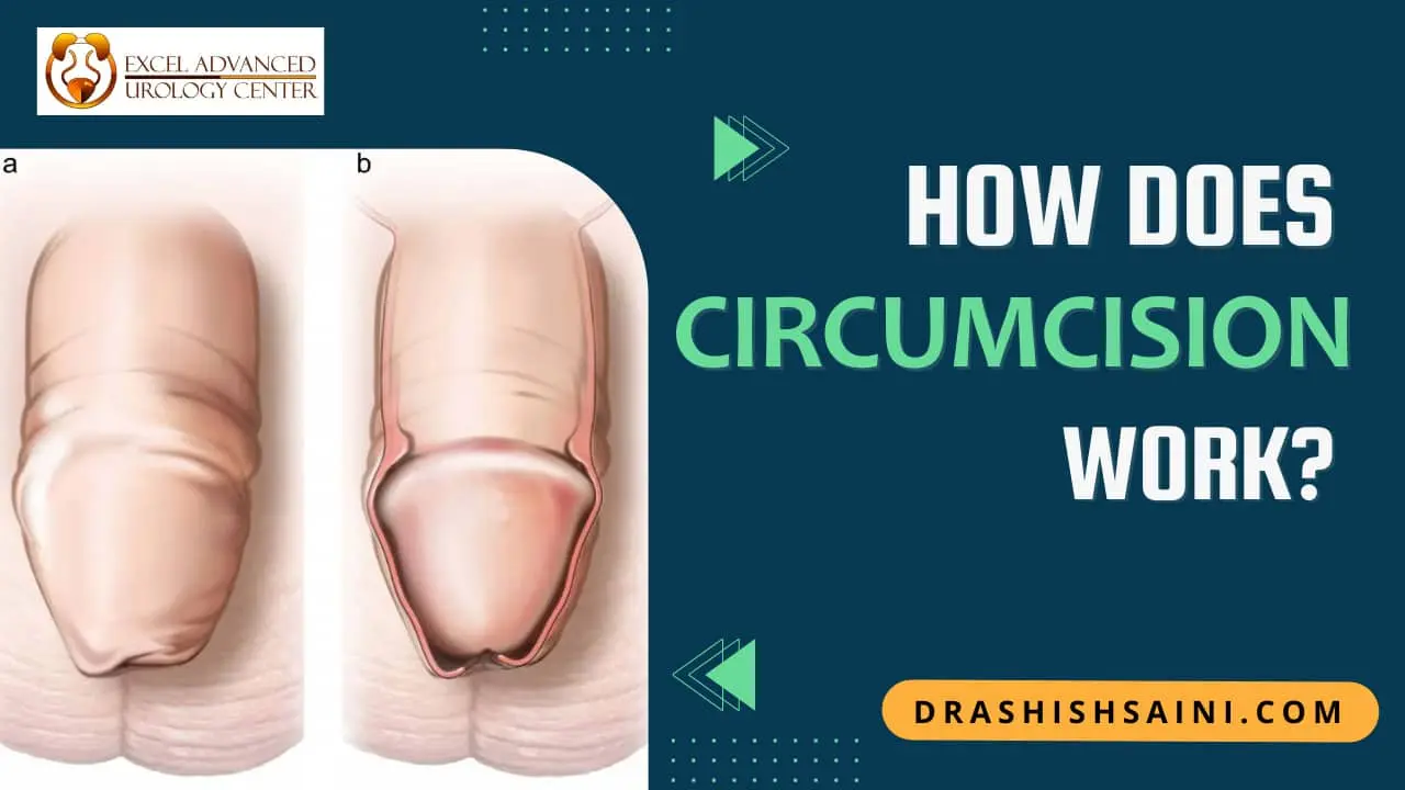 Circumcision – How does it work?