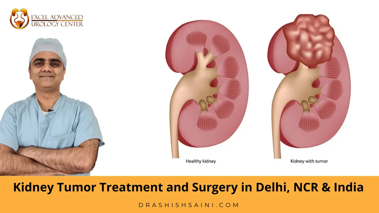 kidney tumour treatment and surgery