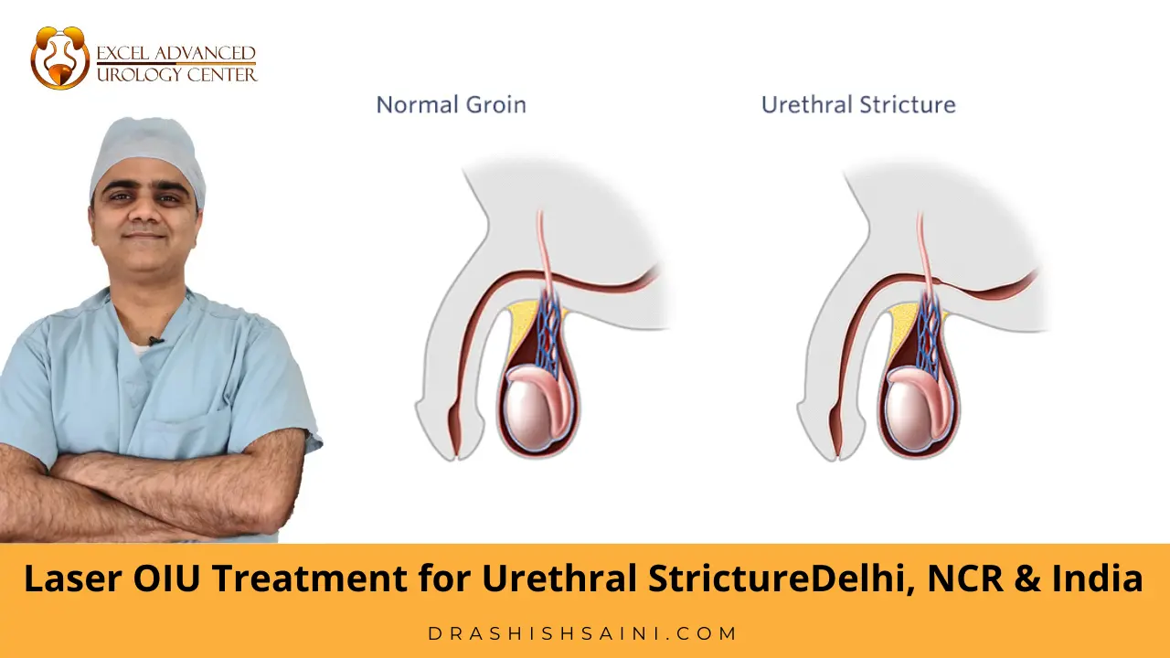 Urethral stricture treatment in delhi - dr ashish saini