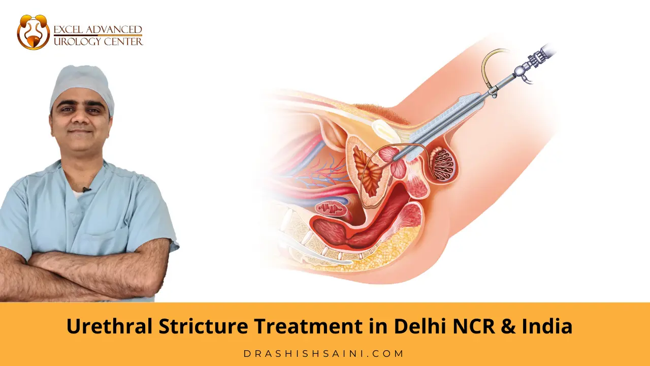 Urethral stricture treatment in delhi