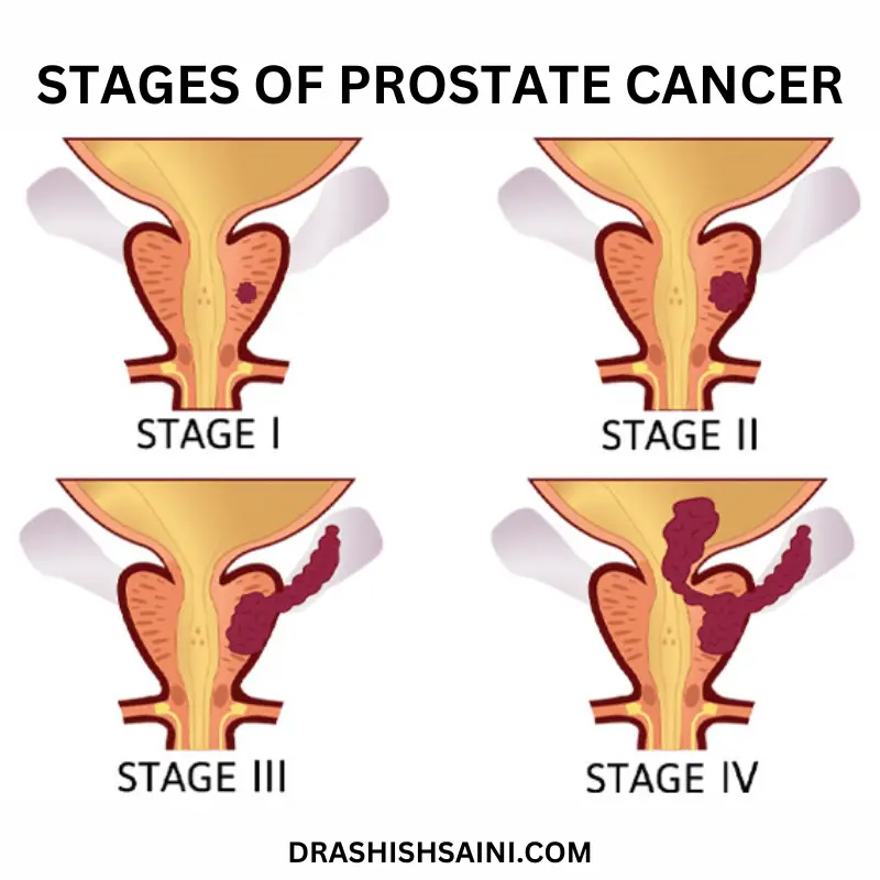 treatment for prostate cancer by dr Ashish Saini - stages of prostate cancer