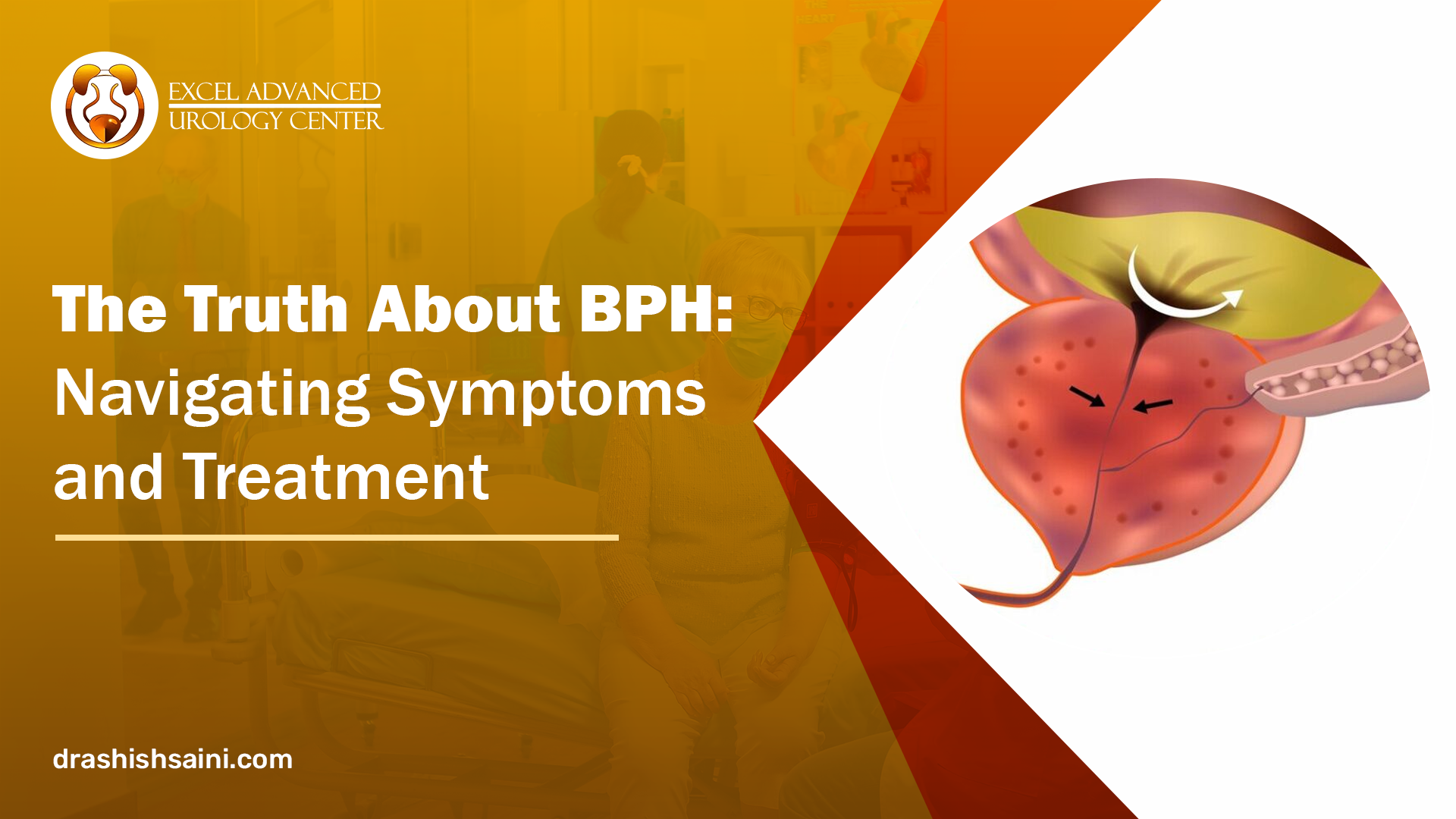 The Truth About BPH: Navigating Symptoms and Treatment